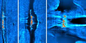 Accélération des protons par impulsions laser : une percée médicale en vue ?