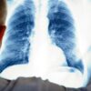 L'âge révélé par radiographie atteint une précision record
