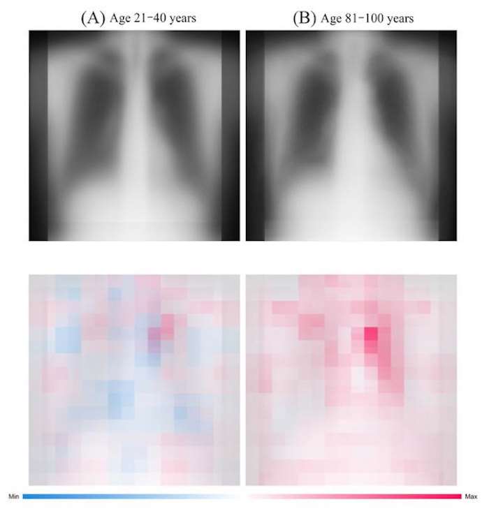 L'âge révélé par radiographie atteint une précision record 2