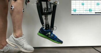 5 personnes amputées retrouvent la stabilité grâce aux chevilles prothétiques robotiques