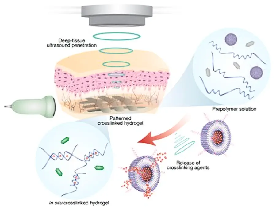 La plateforme d'impression sonore in vivo des tissus profonds (DISP). Cette technique associe les ultrasons à des liposomes sensibles aux basses températures et chargés d'agents de réticulation. Les liposomes, souvent utilisés pour l'administration de médicaments, sont incorporés dans une solution de polymère contenant les monomères du polymère souhaité, un agent de contraste d'imagerie qui révèle la réticulation (ici, les vésicules de gaz utilisées à cette fin sont représentées par des hexagones), et la cargaison qu'ils espèrent délivrer - un médicament thérapeutique, par exemple. Les scientifiques utilisent des ultrasons focalisés pour augmenter de quelques degrés la température d'une zone ciblée, ce qui permet aux liposomes de libérer leur contenu et d'amorcer l'impression à un endroit précis.