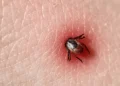 Un antibiotique familier offre un nouvel espoir face à la maladie de Lyme