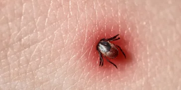 Un antibiotique familier offre un nouvel espoir face à la maladie de Lyme