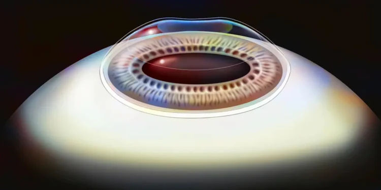 Correction visuelle : une alternative au LASIK - sans les lasers ?