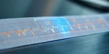 Une IA aide à diagnostiquer une maladie cardiaque souvent non détectée à l'ECG