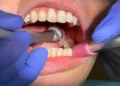 A dental drill being used in a patient’s mouth.