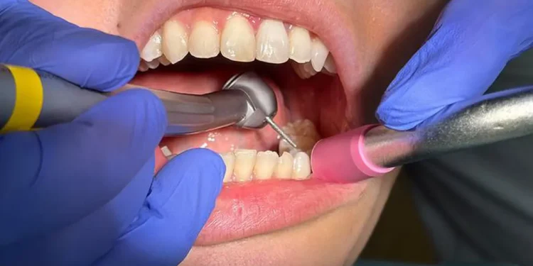A dental drill being used in a patient’s mouth.