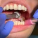 A dental drill being used in a patient’s mouth.