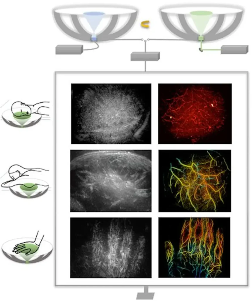 La tomographie hybride par ultrasons rotationnels et photoacoustique (RUS-PAT) combine la tomographie panoramique rapide par ultrasons rotationnels et la tomographie photoacoustique pour permettre une imagerie 3D quasi simultanée de la structure des tissus mous et du système vasculaire. Ce système a été utilisé pour obtenir une imagerie à double contraste et à large champ de vision de plusieurs régions anatomiques humaines, notamment la tête, les seins et les extrémités.
