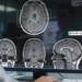 Un modèle d'IA peut lire et diagnostiquer une IRM cérébrale en quelques secondes