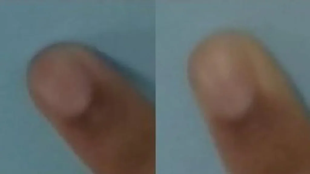 Le blanchiment du bout des doigts se produit lorsqu'un doigt appuie contre une surface dure (phénomène de blanchiment)