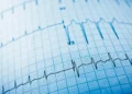 Quand l'IA lit les ECG pour prédire la mort subite cardiaque