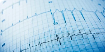 Quand l'IA lit les ECG pour prédire la mort subite cardiaque