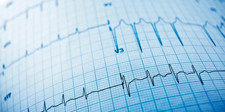 Quand l'IA lit les ECG pour prédire la mort subite cardiaque