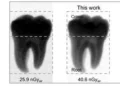 Un nouveau détecteur à pérovskite permet des images radiologiques claires à dose bien plus faible