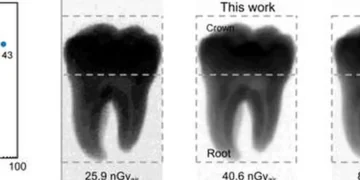 Un nouveau détecteur à pérovskite permet des images radiologiques claires à dose bien plus faible