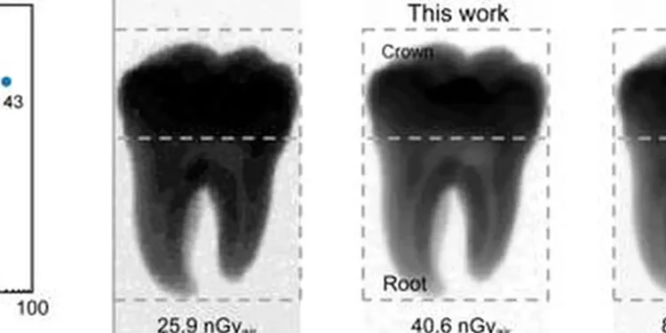 Un nouveau détecteur à pérovskite permet des images radiologiques claires à dose bien plus faible