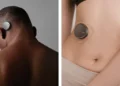 Coherence teste un implant cérébral contre les tumeurs